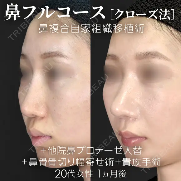 他院鼻プロテーゼ入替＋鼻フルコース［クローズ法］（鼻複合自家組織移植術）＋鼻骨骨切り幅寄せ術＋貴族手術 after画像 メイン用