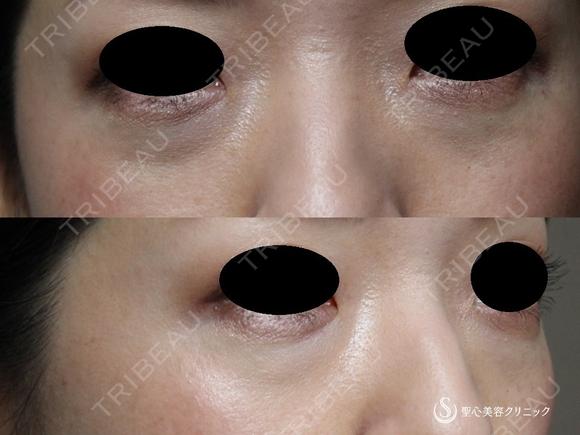 【30代女性・目の下の若返り】プレミアムPRP皮膚再生療法（術後1年） before画像 メイン用