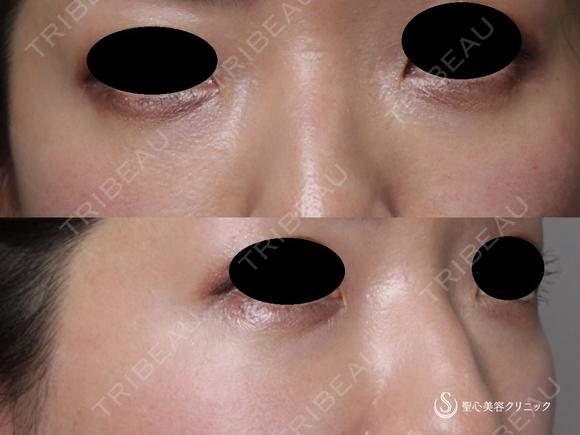 【30代女性・目の下の若返り】プレミアムPRP皮膚再生療法（術後1年） 365日後 メイン用