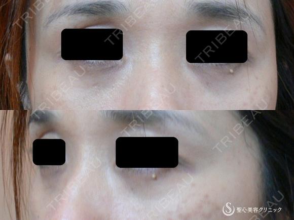 【40代女性・9年以上経過してもこの効果！！】目の下のプレミアムPRP皮膚再生療法（9年後） before画像 メイン用