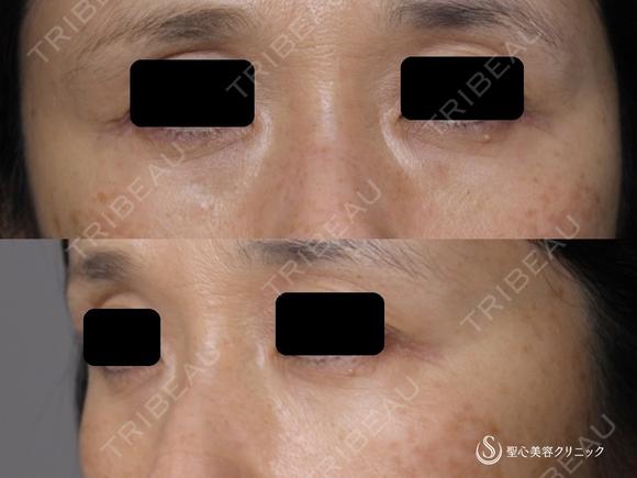【40代女性・9年以上経過してもこの効果！！】目の下のプレミアムPRP皮膚再生療法（9年後） 3285日後 メイン用