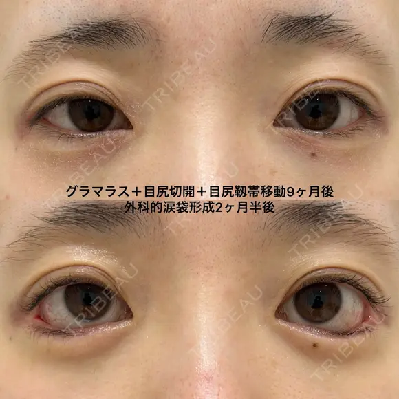 外科的涙袋形成と、たれ目形成の関係性 after画像 メイン用