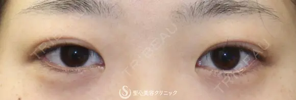 【20代女性・平行型の二重で美人目に】目頭切開（術後3ヶ月） before画像 メイン用