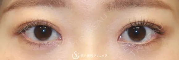 【20代女性・平行型の二重で美人目に】目頭切開（術後3ヶ月） 90日後 メイン用