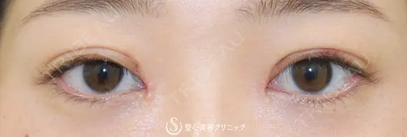 【20代女性・平行型の二重で美人目に】目頭切開（術後3ヶ月） 6日後 メイン用