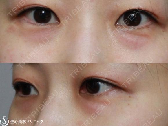 【30代女性・目の下のクマとたるみの改善】プレミアムPRP皮膚再生療法（2ヶ月後） before画像 メイン用