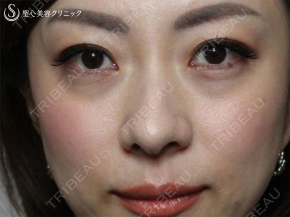【40の女性・目の下のクマ、たるみ、段差】目の下+法令線のプレミアムPRP（7ヶ月後） before画像 メイン用