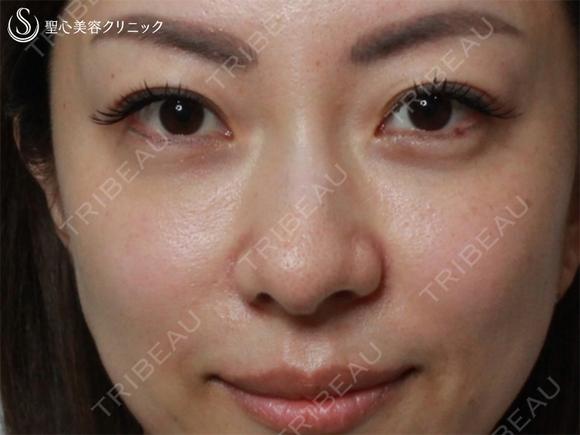 【40の女性・目の下のクマ、たるみ、段差】目の下+法令線のプレミアムPRP（7ヶ月後） 210日後 メイン用