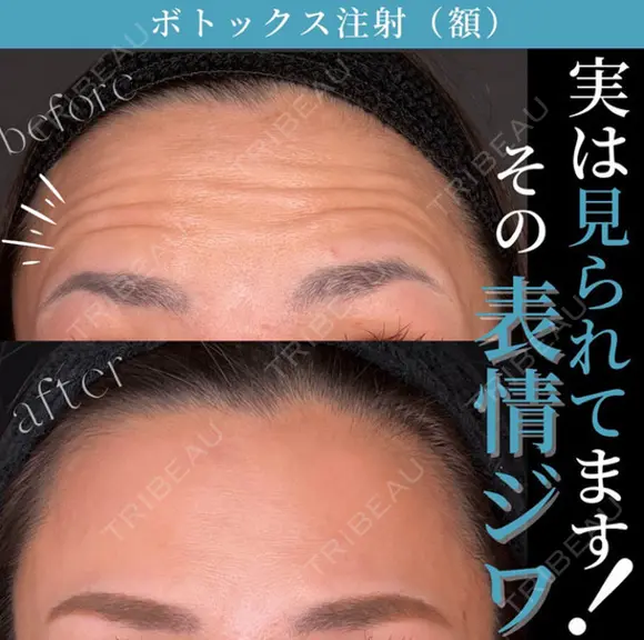 ボトックスビスタ 額　8単位　 after画像 メイン用