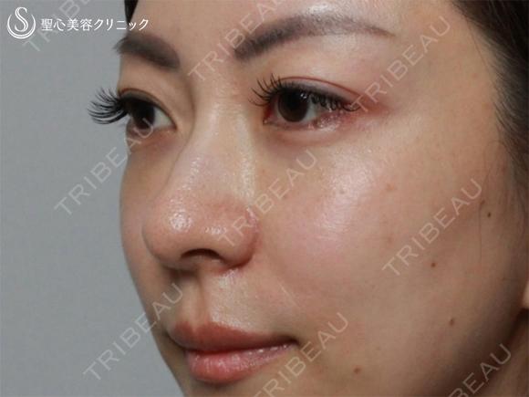 【40の女性・目の下のクマ、たるみ、段差】目の下+法令線のプレミアムPRP（7ヶ月後） after画像 メイン用