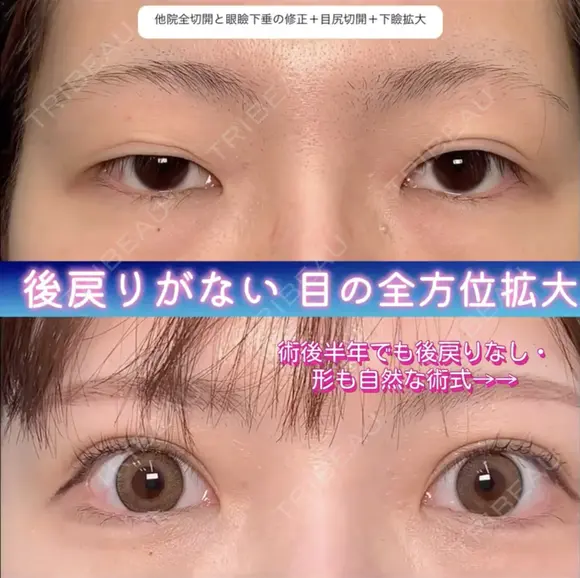 全方位拡大術〜全切開二重術（他院修正）＋目尻切開＋眼瞼下垂単独（他院修正） before画像 メイン用