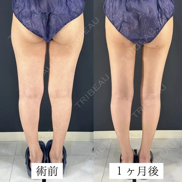 太もも脂肪吸引 after画像 メイン用