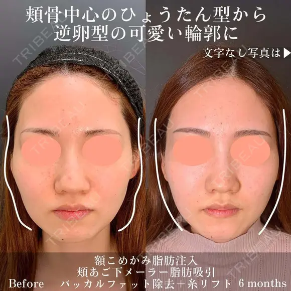 小顔複合〜顔脂肪吸引＋脂肪注入＋糸リフト before画像 メイン用