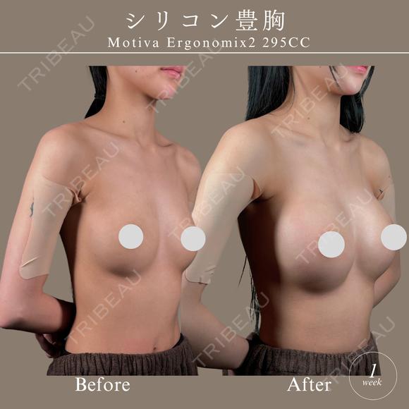 モディバ　シリコンバッグ豊胸 after画像 メイン用