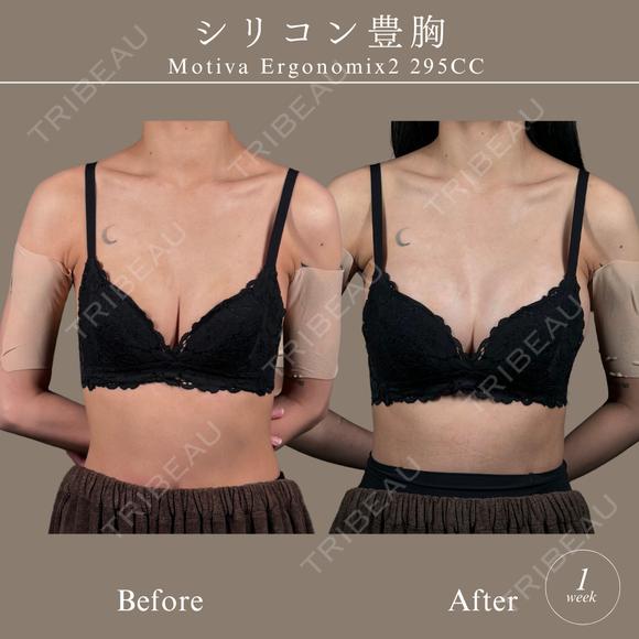 モディバ　シリコンバッグ豊胸 after画像 メイン用