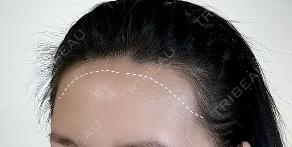 アートメイクヘアライン before画像 メイン用