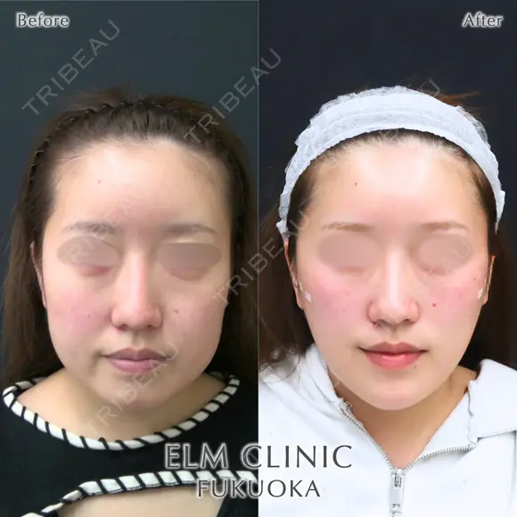 小顔治療（糸リフト、ヒアルロン酸、ボトックス） after画像 メイン用