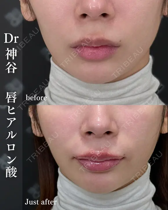 唇ヒアルロン酸 before画像 メイン用