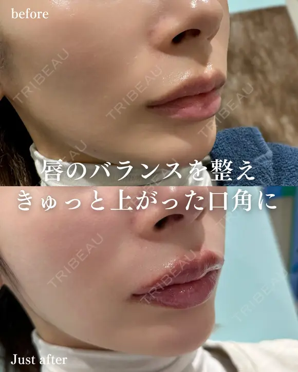 唇ヒアルロン酸 after画像 メイン用
