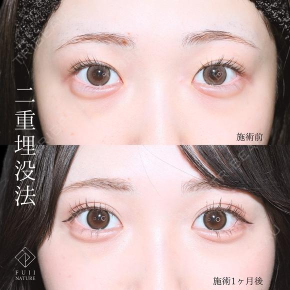 選べるオーダメイド二重埋没法 after画像 メイン用