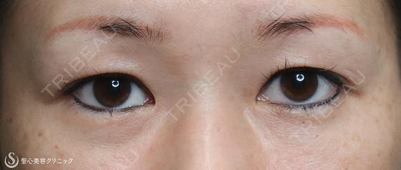 【40代女性・二重幅を拡げたい】眉下切開＋埋没法（左１点）（眉下切開抜糸時に埋没法） before画像 メイン用