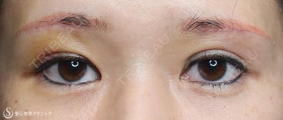 【40代女性・二重幅を拡げたい】眉下切開＋埋没法（左１点）（眉下切開抜糸時に埋没法） 6日後 メイン用