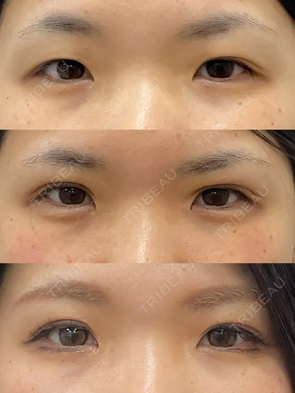 二重埋没法2点留め before画像 メイン用