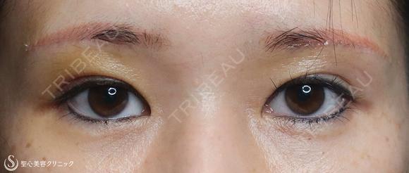 【40代女性・二重幅を拡げたい】眉下切開＋埋没法（左１点）（眉下切開抜糸時に埋没法） 6日後 メイン用