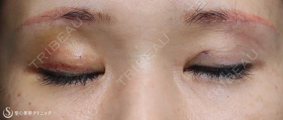 【40代女性・二重幅を拡げたい】眉下切開＋埋没法（左１点）（眉下切開抜糸時に埋没法） 6日後 メイン用