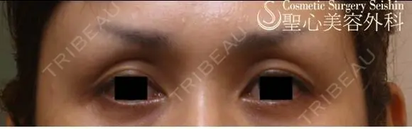 【目の上のくぼみ】プレミアムPRP皮膚再生療法 before画像 メイン用