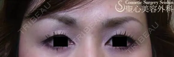 【目の上のくぼみ】プレミアムPRP皮膚再生療法 after画像 メイン用