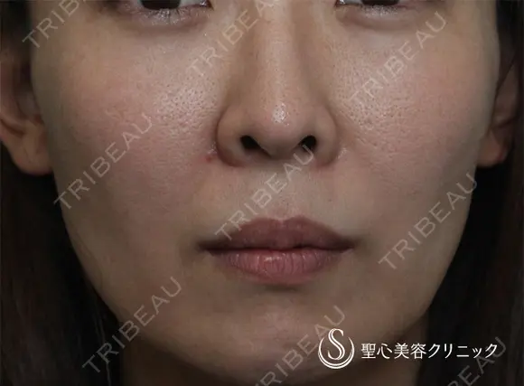 【女性・ほうれい線、たるみ改善後２年経過】プレミアムPRP皮膚再生療法（２年後） 730日後 メイン用
