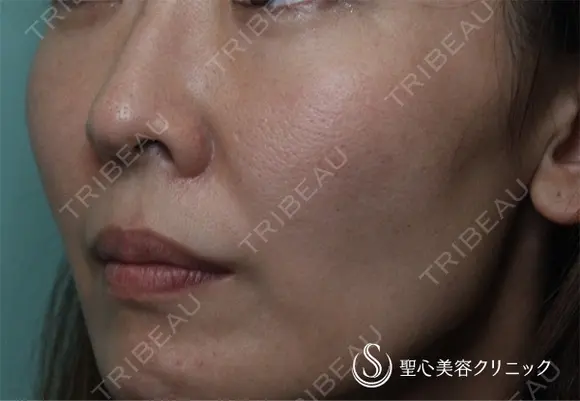 【女性・ほうれい線、たるみ改善後２年経過】プレミアムPRP皮膚再生療法（２年後） 730日後 メイン用