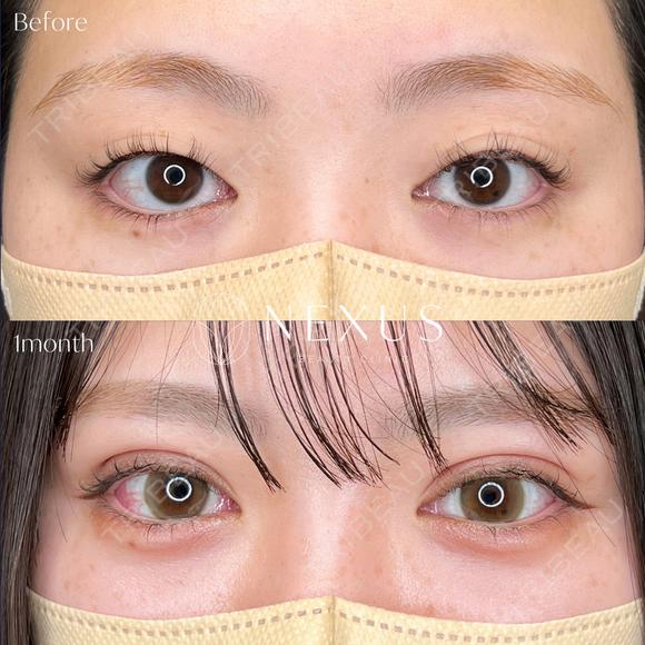 ネクサスアイズ(埋没法) after画像 メイン用