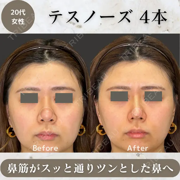 テスノーズ before画像 メイン用