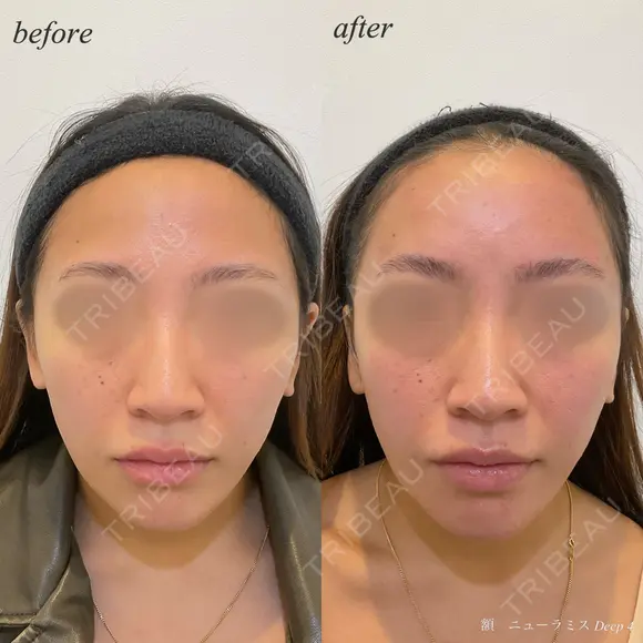 額　ヒアルロン酸注入 before画像 メイン用