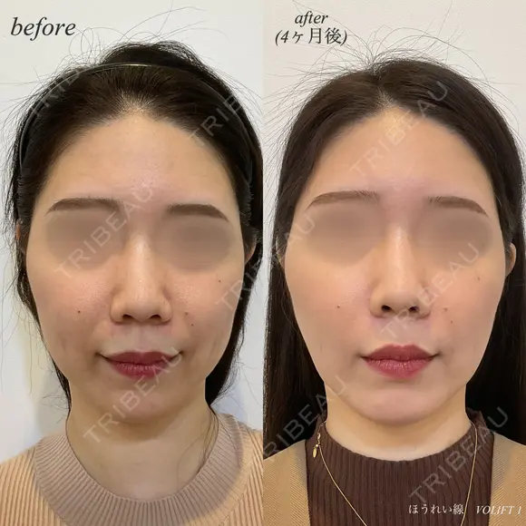 ほうれい線ヒアルロン酸注入 before画像 メイン用