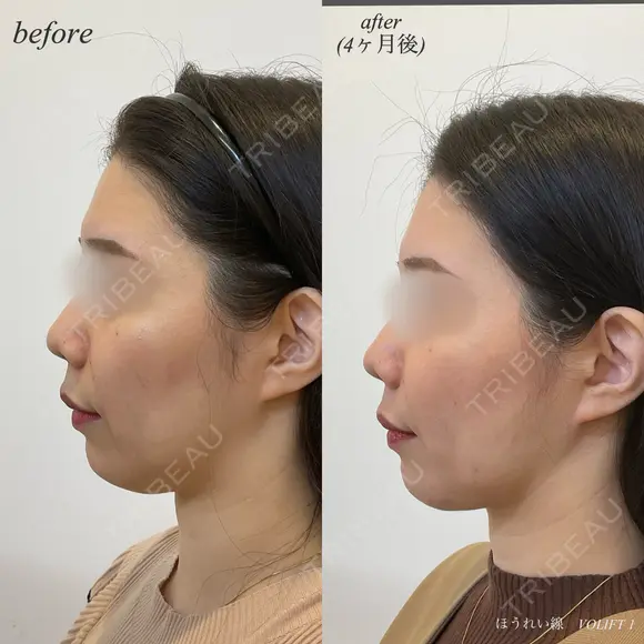 ほうれい線ヒアルロン酸注入 after画像 メイン用