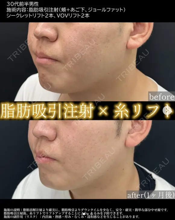 💉脂肪吸引注射＋🪡糸リフトでくっきりフェイスライン、小顔を実現😉 before画像 メイン用