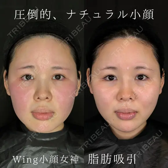Wing小顔女神脂肪吸引 before画像 メイン用