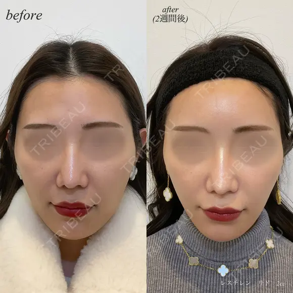 額ヒアルロン酸注入 before画像 メイン用