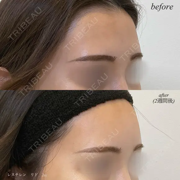 額ヒアルロン酸注入 after画像 メイン用