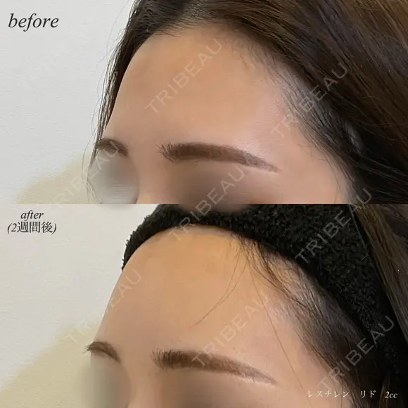 額ヒアルロン酸注入 after画像 メイン用