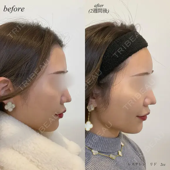 額ヒアルロン酸注入 after画像 メイン用