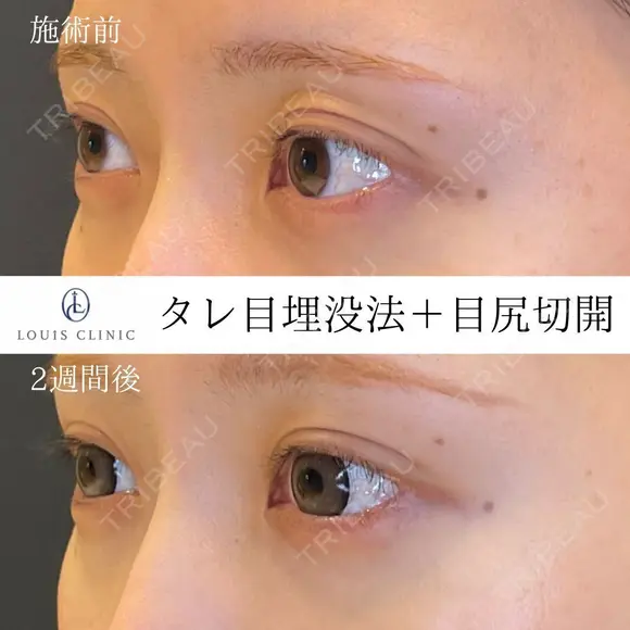 タレ目埋没法＋目尻切開 14日後 メイン用