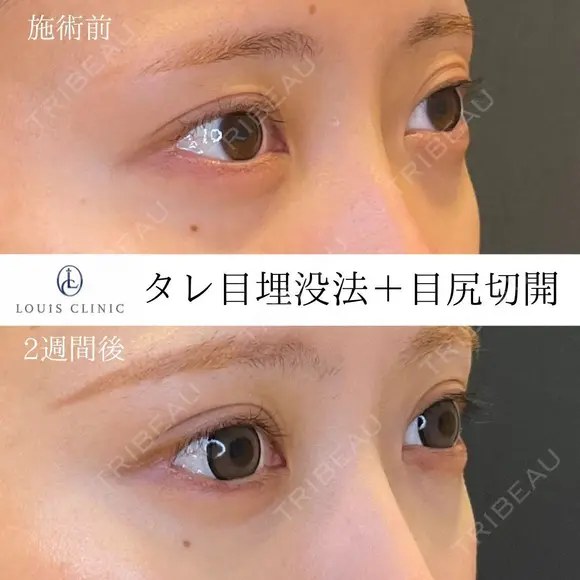 タレ目埋没法＋目尻切開 14日後 メイン用