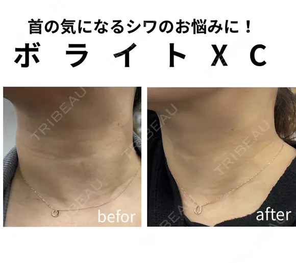 アラガン社製ボライトXC 7日後 メイン用