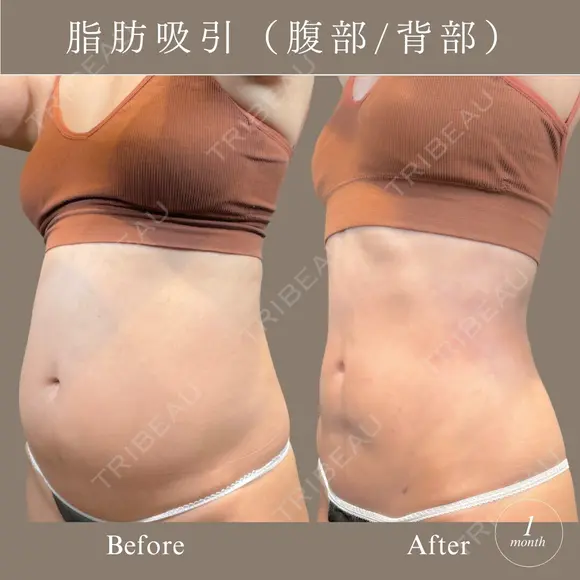 腹部脂肪吸引セット after画像 メイン用