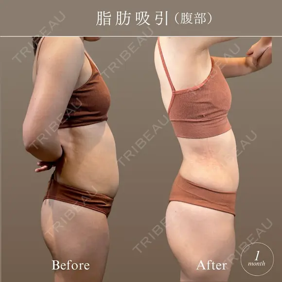 腹部脂肪吸引セット after画像 メイン用