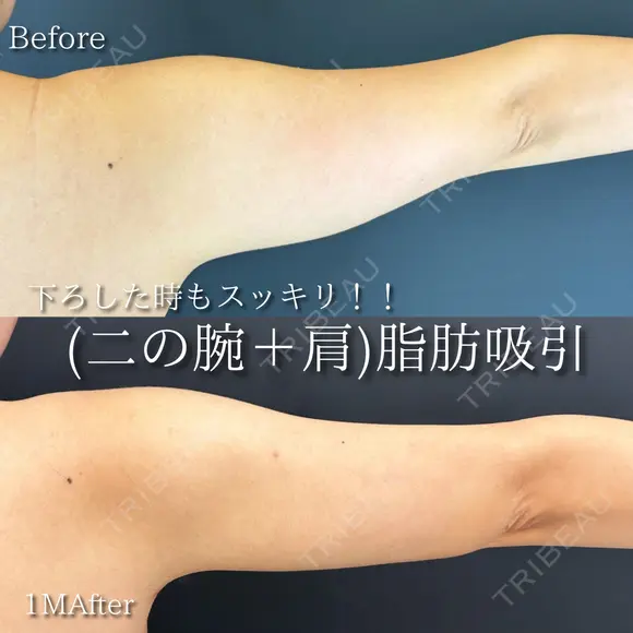 （二の腕+肩）脂肪吸引✨ 30日後 メイン用